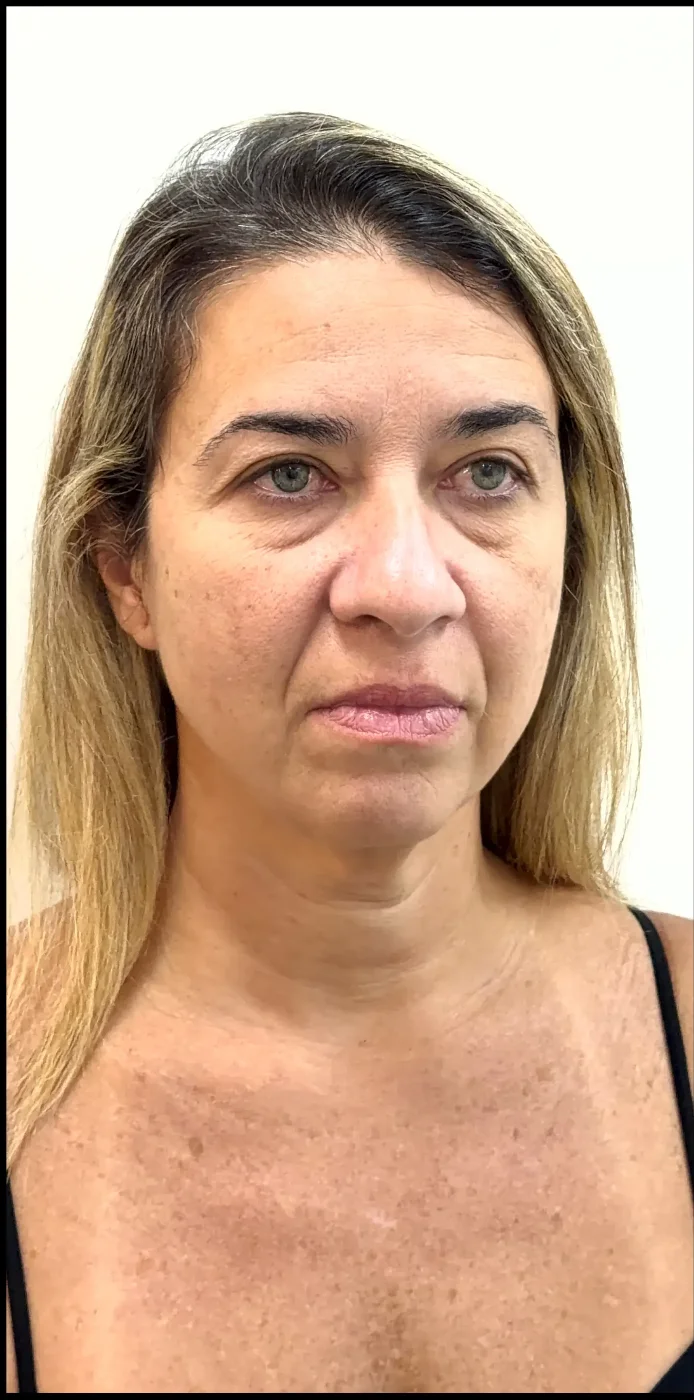 Paciente de Lifting Total antes da cirurgia — Clínica Eros