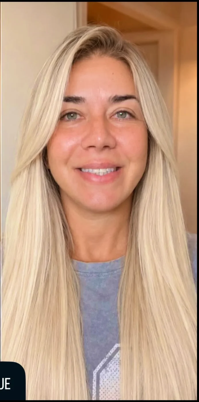 Paciente de Lifting Total depois da cirurgia — Clínica Eros