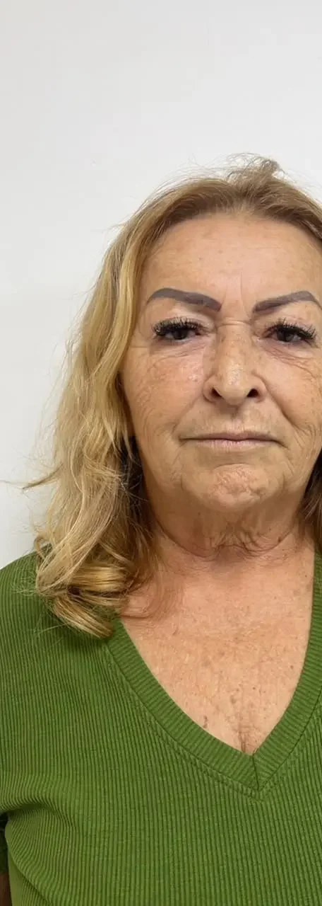 Paciente de Lifting Total antes da cirurgia — Clínica Eros