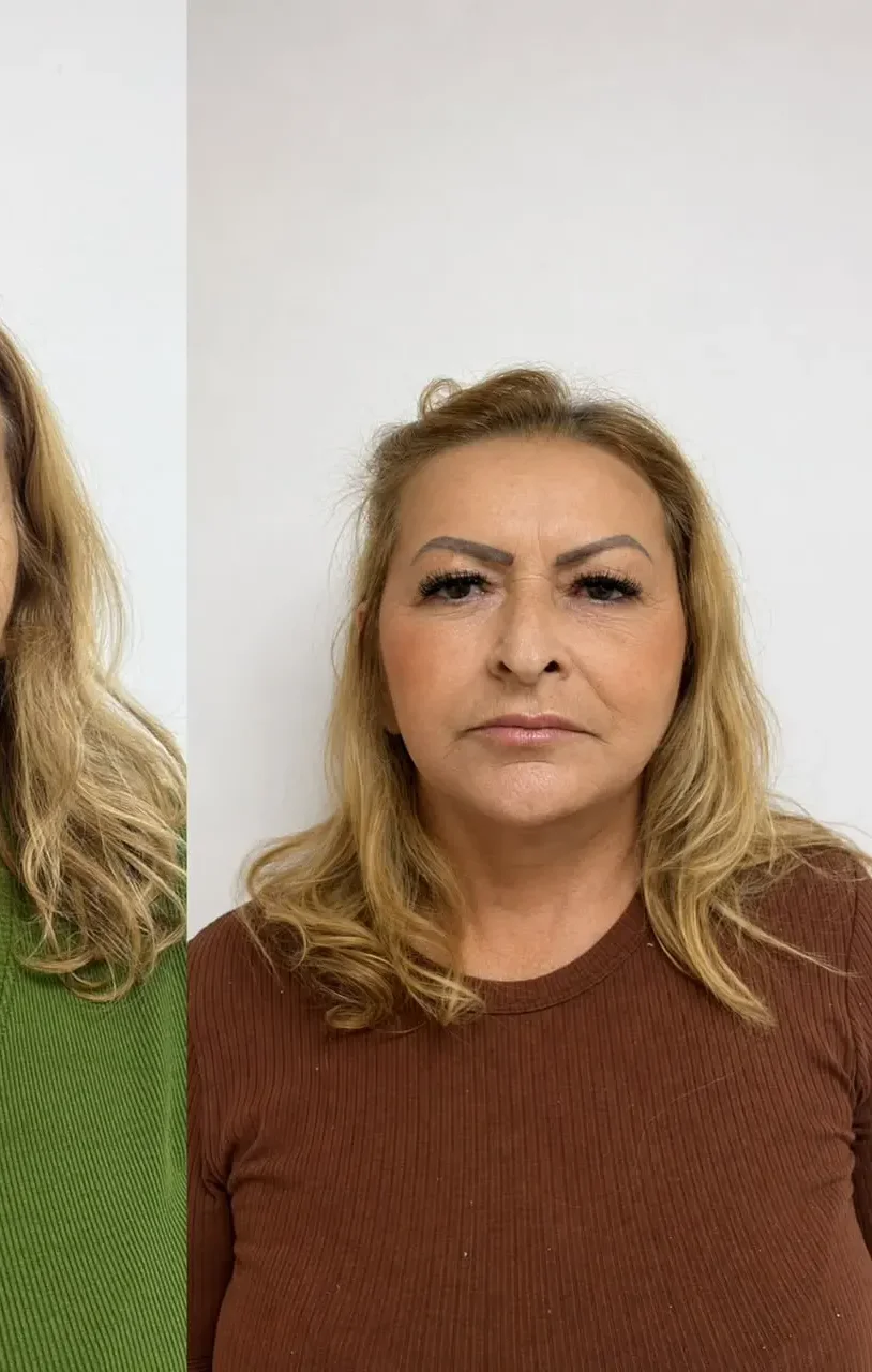 Paciente de Lifting Total depois da cirurgia — Clínica Eros