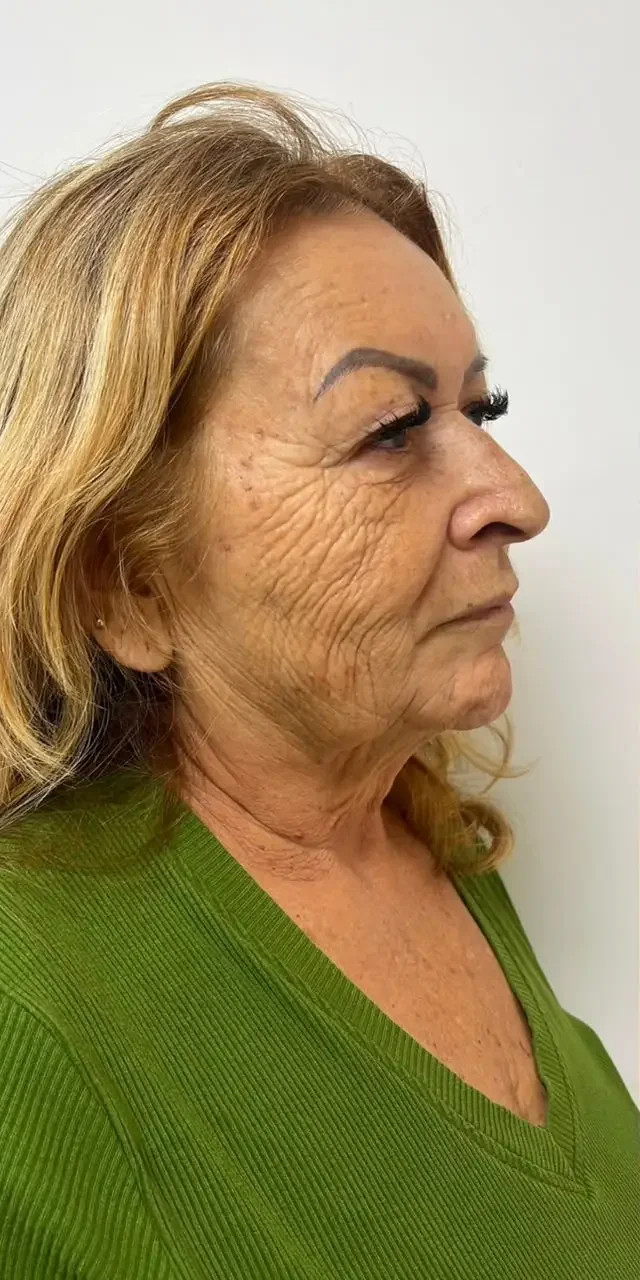Paciente de Lifting Total antes da cirurgia — Clínica Eros