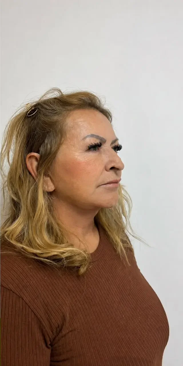 Paciente de Lifting Total depois da cirurgia — Clínica Eros
