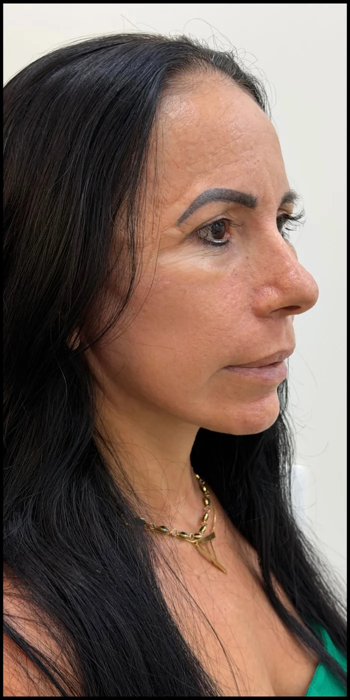 Paciente de Mini Lifting depois — Clínica Eros