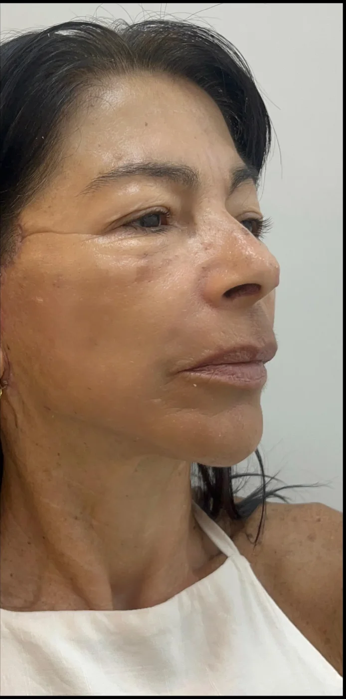 Paciente de Mini Lifting depois — Clínica Eros
