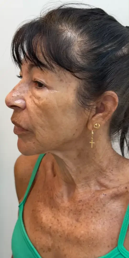 Paciente de Mini Lifting antes — Clínica Eros