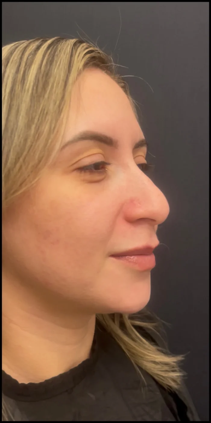 Paciente de Rinoplastia antes — Clínica Eros