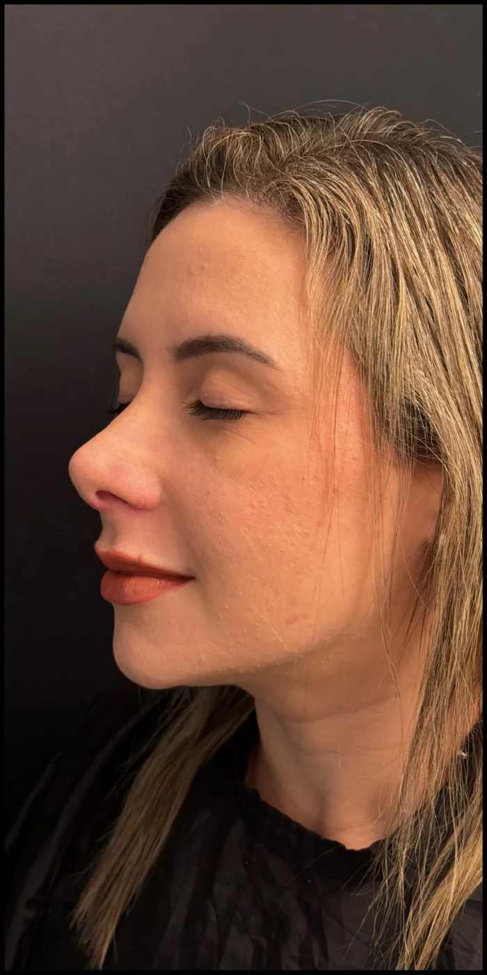 Paciente de Rinoplastia depois — Clínica Eros