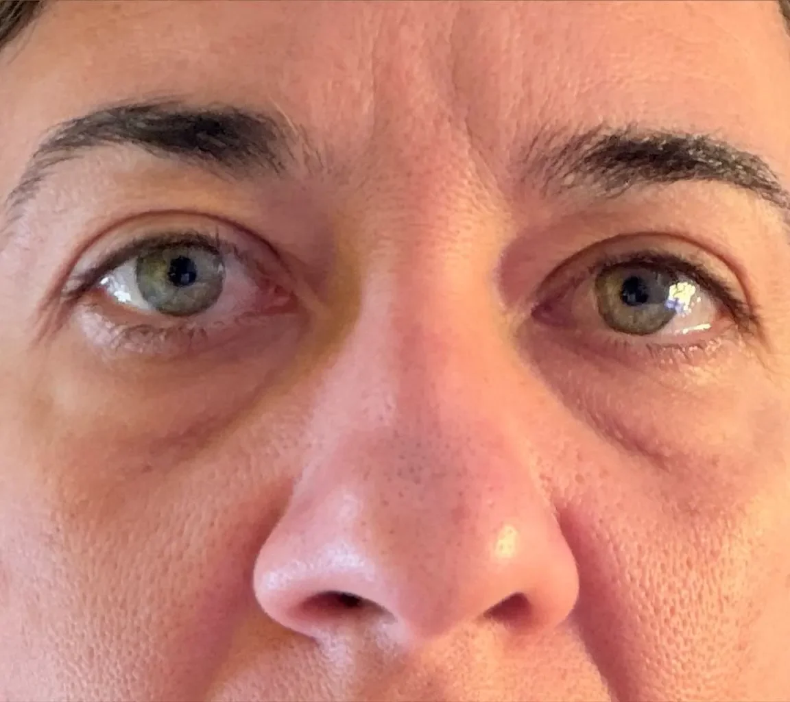 Sobrancelha depois — Clínica Eros